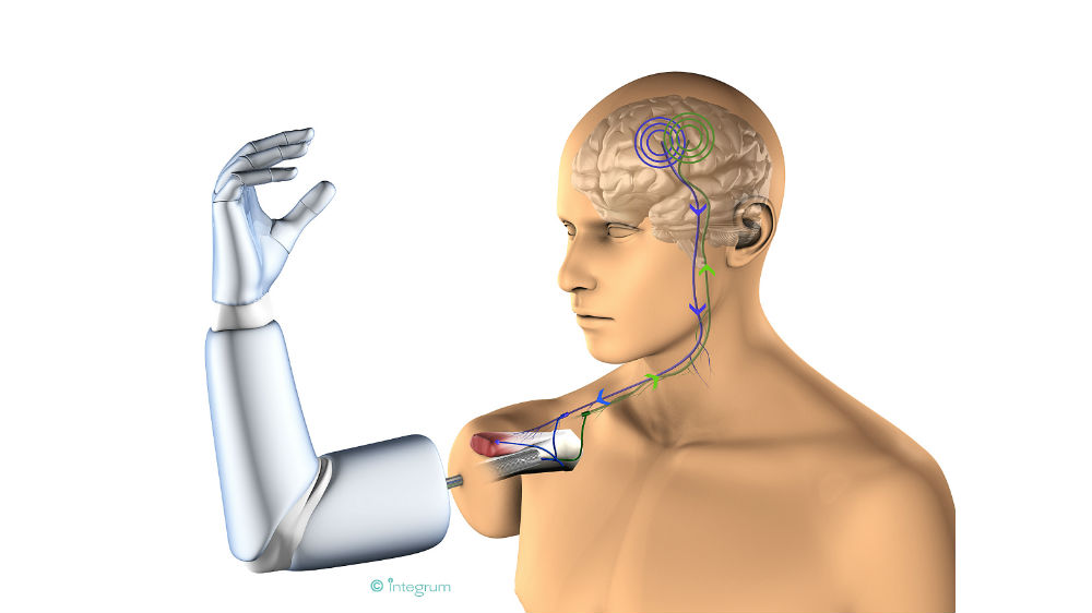 prosthetic-arm-directly-connected-bone-muscles-nerves