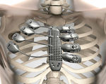 Man gets 3d printed metal ribs surgically inserted after doctors removed cancerous tumors