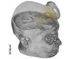 Focused ultrasound pulsation wakes coma jump starting neurons